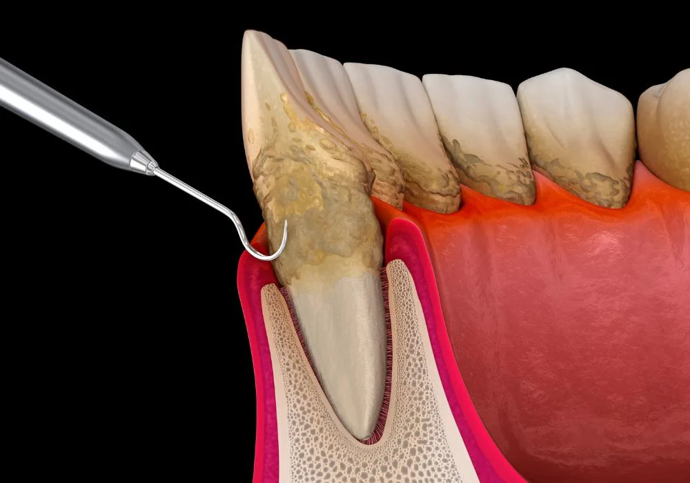 Dentiste Lyon - Surfaçage radiculaire
