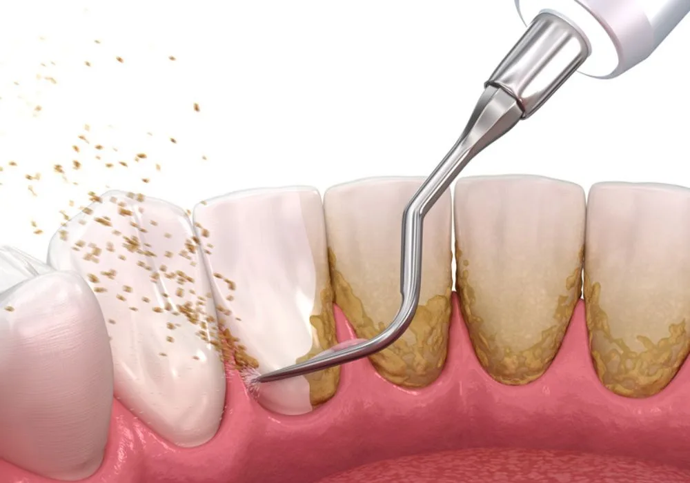 Dentiste Lyon - Détartrage