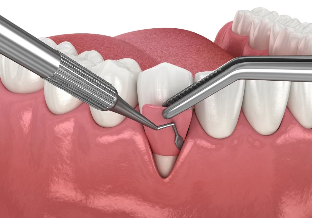 Dentiste Lyon - Greffe gingivale