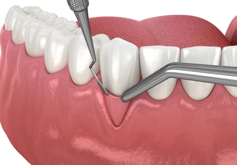 Dentiste Lyon - Greffe gingivale