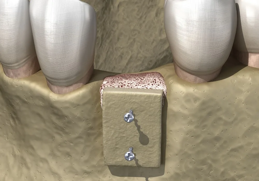 Dentiste Lyon - régénération parodontale