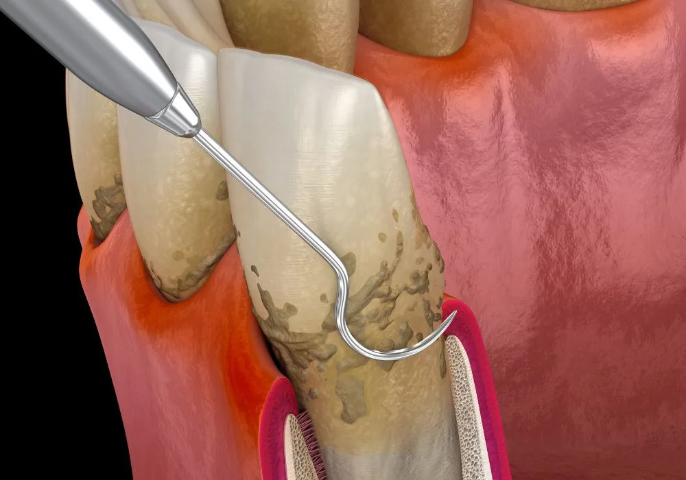 Dentiste Lyon - Surfaçage radiculaire